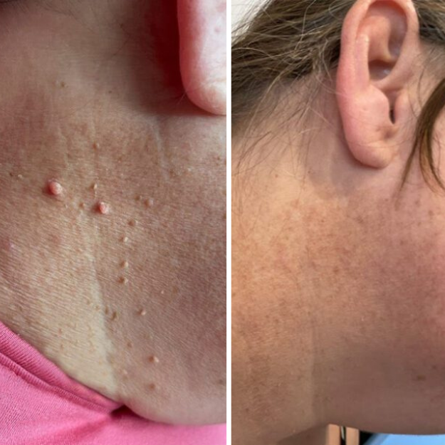 MySkiné™ ¡No más marcas en la piel! ✨